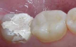Почему после установки временной пломбы может болеть зуб, что делать и сколько можно держать лекарство?