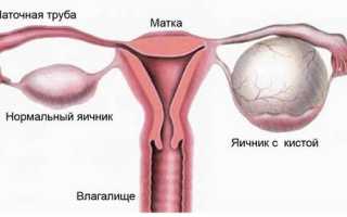 Киста левого яичника у женщин: причины возникновения, симптомы и лечение