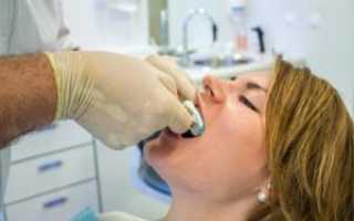 Как делают слепки для процедуры протезирования зубов и брекетов: техника, используемые материалы