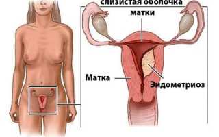 Как распознать симптомы эндометриоза матки?