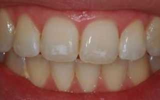 Пигментный налет и пятна на зубах: фото и описание патологии, причины и лечение
