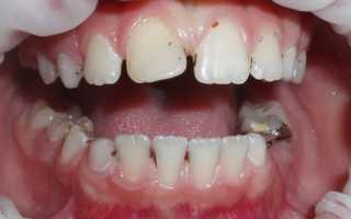 Причины и лечение налета Пристли на зубах у детей: как объясняет появление черных пятен Комаровский и что делать?