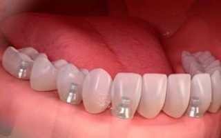 Как долго служат зубные импланты, нужно ли их снимать по истечении срока годности и что делать потом?