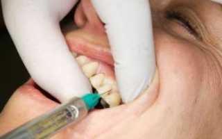 Больно делать укол перед удалением зуба и почему болит десна после анестезии?