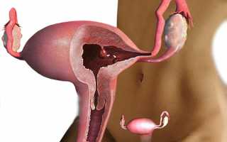 Методы лечения и профилактики полипов эндометрия в матке