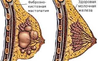 Шишка в груди у женщин: причины появления и лечение