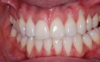 Оголяются корни и шейки зубов: что делать, как проходит лечение у стоматолога и в домашних условиях?