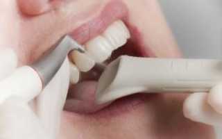 На сколько часто можно делать гигиеническую чистку зубов и полости рта: этапы и виды процедуры, фото до и после