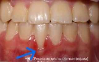 Рецессия или оголение шейки зуба: причины опущения десен, классификация, способы лечения и восстановления