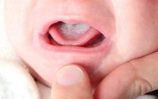Стоматит у детей: как выглядит патология, почему появляется на языке и во рту и чем ее лечить?