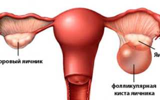 Фолликулярная киста яичника у женщин: причины, симптомы и лечение