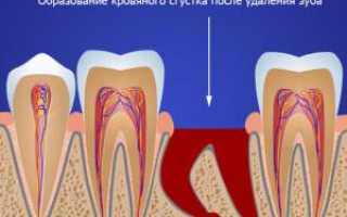 Сколько времени после удаления зуба болит и заживает десна, как долго зарастает рана?