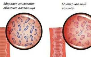 Дисбактериоз влагалища: причины, симптомы, лечение