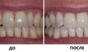 Особенности реминерализации зубов у стоматолога и в домашних условиях: гели, пасты и капы для эмали