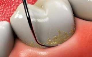 Зубной камень: как происходит чистка зубов от него, больно ли это, фото до и после удаления и цены