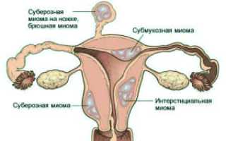 Три основных подхода к лечению миомы матки