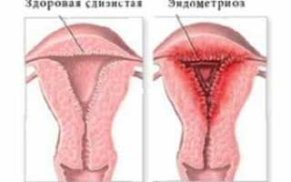 Причины задержки месячных: почему менструации не начинаются вовремя?