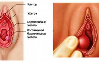 Воспаление бартолиновой железы у женщин: причины, симптомы, лечение
