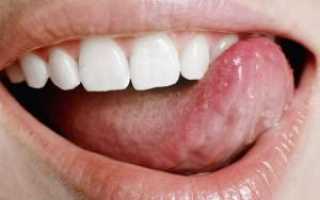 Применение антибиотиков в стоматологии: какие препараты показаны при воспалении надкостницы, десен и корней зубов?