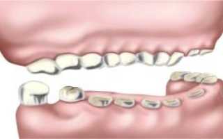 Лечение и профилактика патологической стираемости зубов: что делать, если сточились передние единицы?
