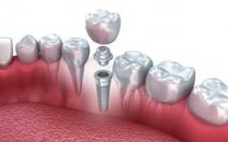 Какие коронки лучше ставить на зубной имплант: изготовление и установка циркониевых и металлокерамических протезов