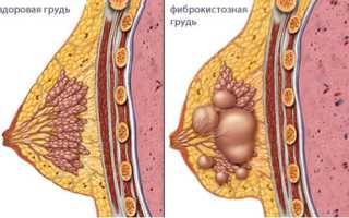 Симптомы, диагностика и лечение мастопатии молочных желез