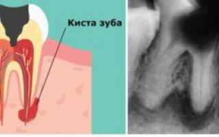 Показания к цистэктомии и цистотомии зуба, отличия процедур и особенности их проведения в стоматологии