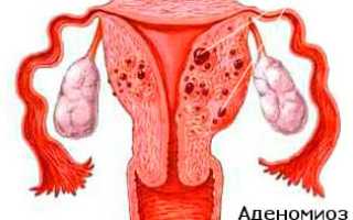 Эндометриоз у женщин: причины, симптомы, лечение медикаментами и народными средствами