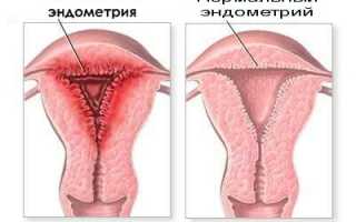 Эндометрит и эндометриоз у женщин: причины заболеваний, симптомы и лечение
