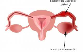 Почему болит левый яичник у женщин: причины, симптомы и лечение в домашних условиях