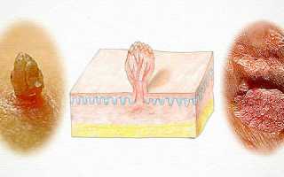 Виды кондилом во влагалище – лечение и способы их удаления в гинекологии