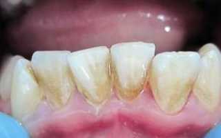 Почему зубы стали черными: причины потемнения эмали снаружи и изнутри, у корня и под пломбой
