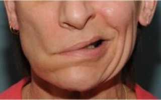 Воспаление лицевого нерва: симптомы и лечение народными средствами в домашних условиях