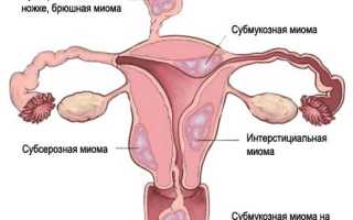 Фибромиома матки: классификация, причины образования, симптомы и методы лечения