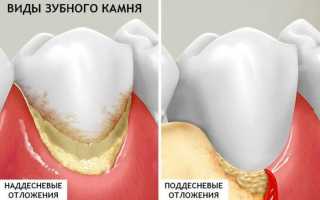 Признаки поддесневого и наддесневого зубного камня, особенности лечения десен