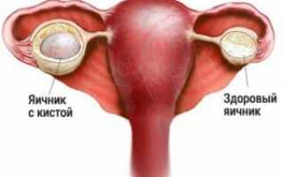 Киста яичника и беременность – влияние патологии на репродуктивную функцию