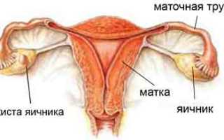 Киста на яичнике у женщины: способы лечения и оперативное вмешательство