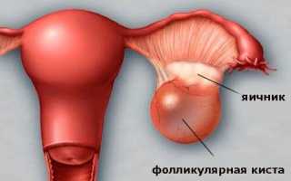Функциональная киста яичника у женщин: причины, симптомы и лечение