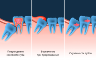 Удаление зуба мудрости: уход после операции и рекомендации при сухой лунке и воспалении десны