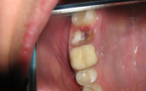 Образование белого фибринозного налета в лунке на десне после удаления зуба: фото и необходимое лечение