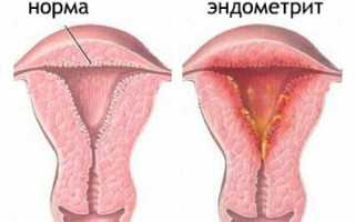 Методы лечения хронического эндометрита и их эффективность
