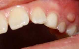 Почему не десне над зубом появился белый прыщ: способы избавления, особенности лечения, фото