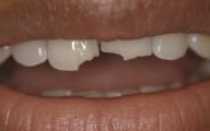 Что делать, если у зуба откололась стенка до уровня десны, можно ли его нарастить?