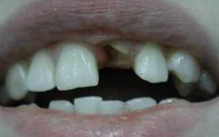 Что делать, если зуб сломался, а в десне остался корень: можно ли восстановить зубную единицу?