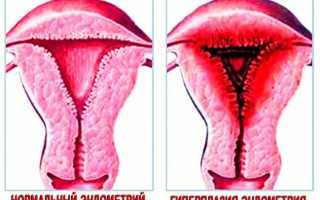 Гиперплазия эндометрия у женщин: что это такое, причины, симптомы, лечение и последствия
