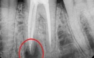 Что делать при воспалении корня зуба: лечение у врача и в домашних условиях