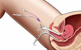 ГСГ маточных труб – современный метод диагностики в гинекологии