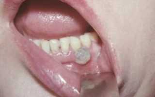 Образование нароста на десне у детей и взрослых: после удаления зуба, при прорезывании и по другим причинам