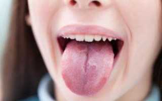 Почему у ребенка бывает пятнистый язык, о чем говорит черный или коричневый налет: фото, возможный диагноз и лечение