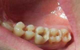Что делать, если пломба выпала из зуба, сколько можно ходить с дыркой?